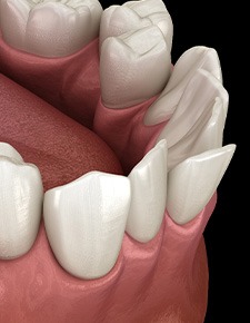Illustration of crooked teeth