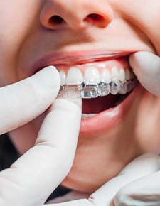 Dentist putting clear aligner on patient