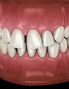 Illustration of gapped teeth