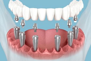 Illustration showing six dental implants in lower jaw