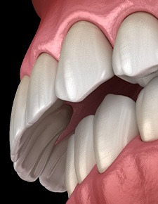 Illustration of an overbite