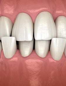 Illustration of a crossbite