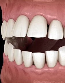 Illustration of an open bite