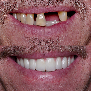 Smile before and after all on four dental implants