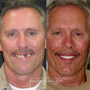 Man sharing smile before an after all on 4 dental implants