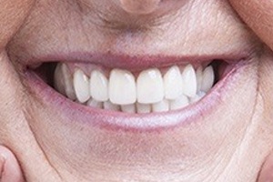 Closeup of flawless smile with all on four dental implants