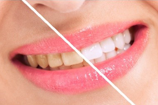 Before and after teeth whitening