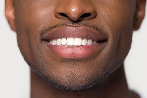 Closeup of smile with direct dental bonding in Friendswood