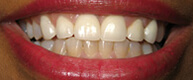 Patient 4 Smile after restoration