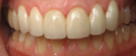 Patient 5 Smile after top row of teeth are restored