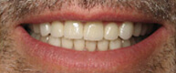 Patient 7 Fully restored smile
