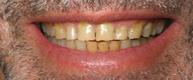 Patient 7 smile before restoration
