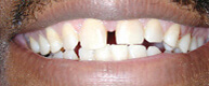 Patient 8 Gapped front teeth