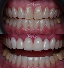 Smile before and after cerec same day dentistry