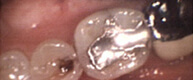 Patient 5 Teeth with silver fillings