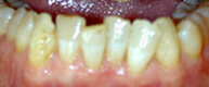 Patient 6 bottom row of teeth before
