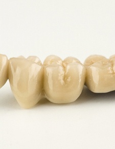 A dental bridge prior to placement
