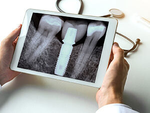 X-ray of dental implant in Friendswood after placement