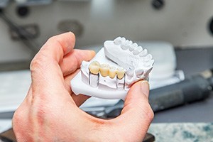 Dental bridge on a clay model