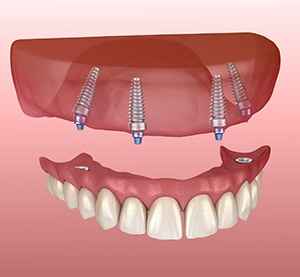 Model of an implant denture