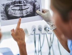 Patient and dentist looking at X-ray discussing cost of dental implants in Friendswood