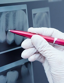Pen pointing to x-ray of root canal treated tooth