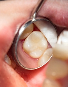 Dental mirror magnifying smile after tooth colored fillings