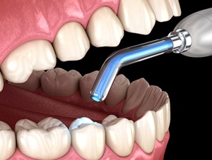 Computer model of a tooth colored filling being cured