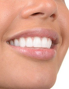 Closeup of woman's smile after porcelain veneers