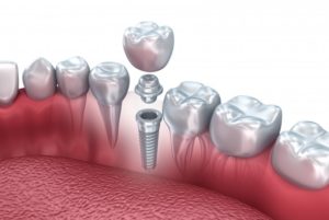 dental implant screwed into bone