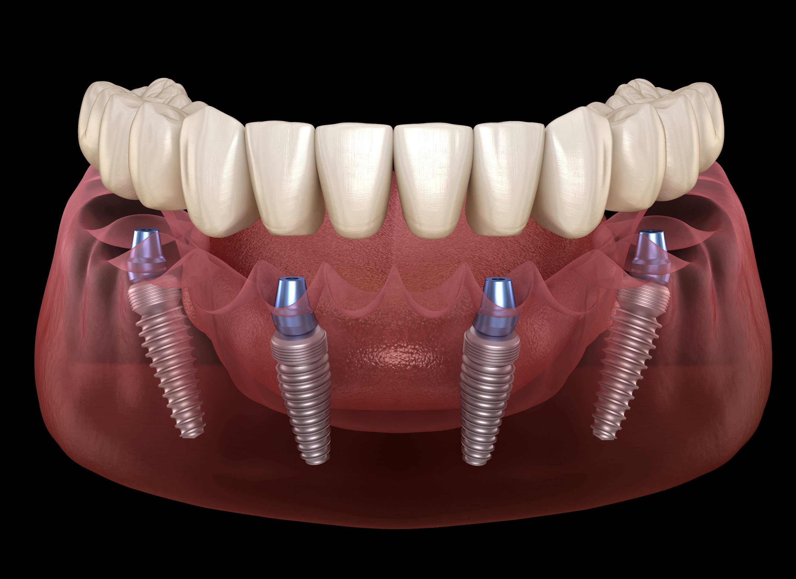 How Long Do All-on-4 Implants Last? Here's What You Need to Know