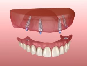 Image of All-On-4 dental implants