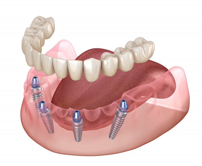 Illustration of all-on-4 dental implants with denture