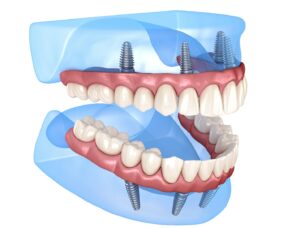 Digital rendering of All-on-4 dental implants.